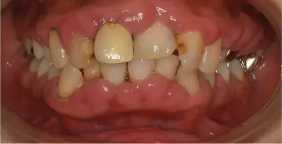 モコモコと腫れていた歯ぐきが改善されました：治療前の口腔内写真