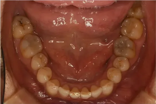多量に付着した歯石を除去、口臭も気にならなくなりました：治療後の口腔内写真